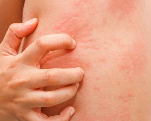 Cold Allergy: Doctor Describes Symptoms