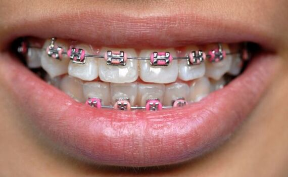 Orthodontist showing a tooth model to the patient