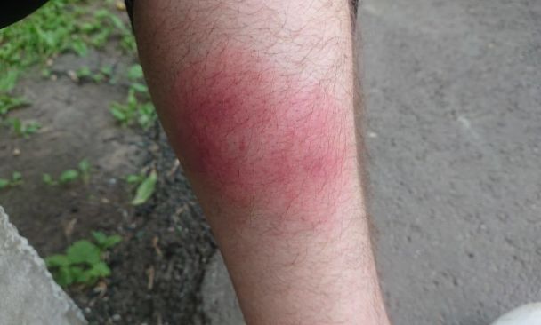 Groźny owad w Polsce: ukąszenie może prowadzić do paraliżu