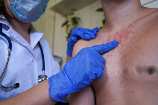 Londyn walczy z epidemią odry. Niska wyszczepialność przyczyną dziesiątek zachorowań wśród dzieci