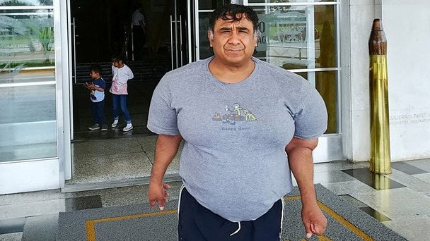 Peruwiański rybak żyje z azotowymi pęcherzykami pod skórą: unikalny przypadek choroby dekompresyjnej