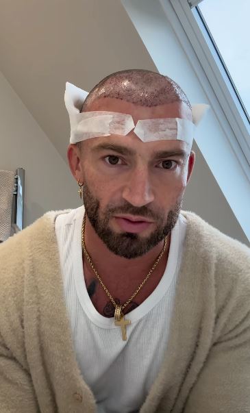 Jake Quickenden on his third hair transplant: how his appearance will change