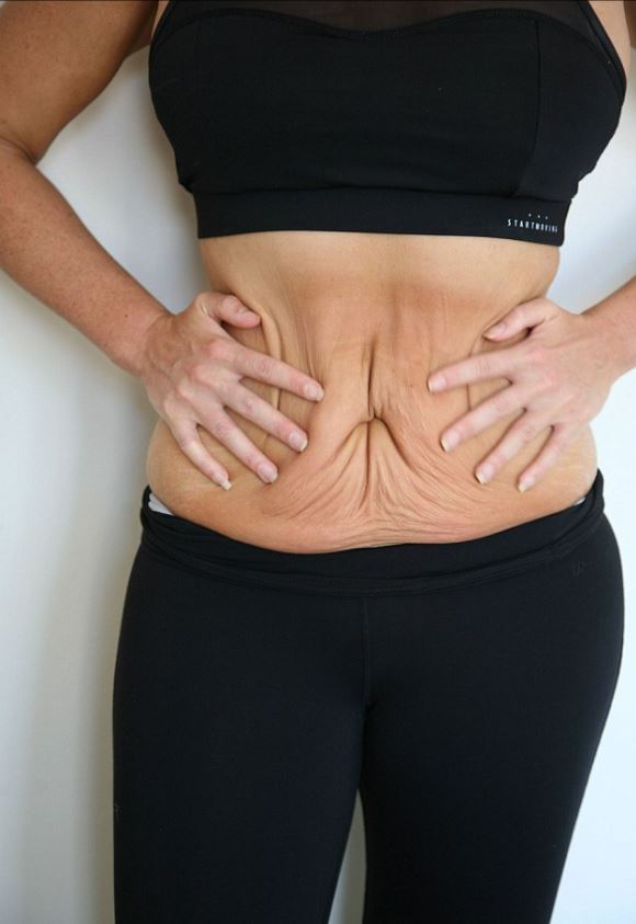 Josie Gibson po nagłej utracie wagi: jak abdominoplastyka zmieniła jej ciało