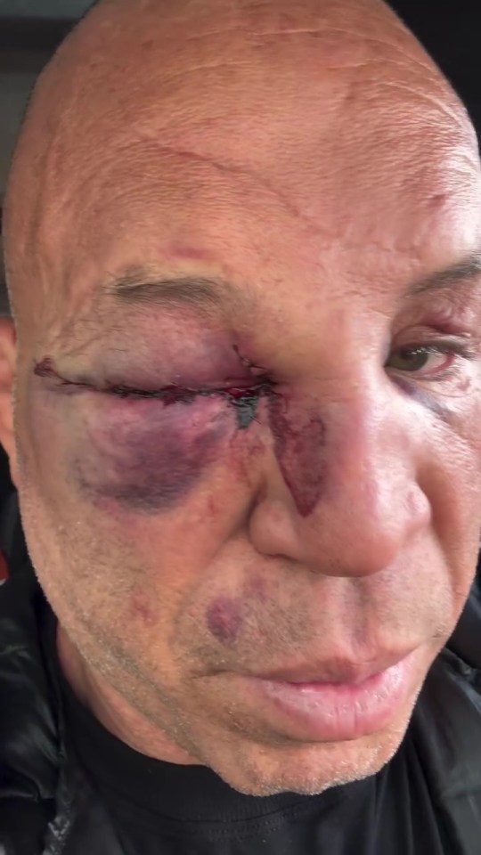 Екс-зірку UFC нокаутували після бою: показавши наслідки