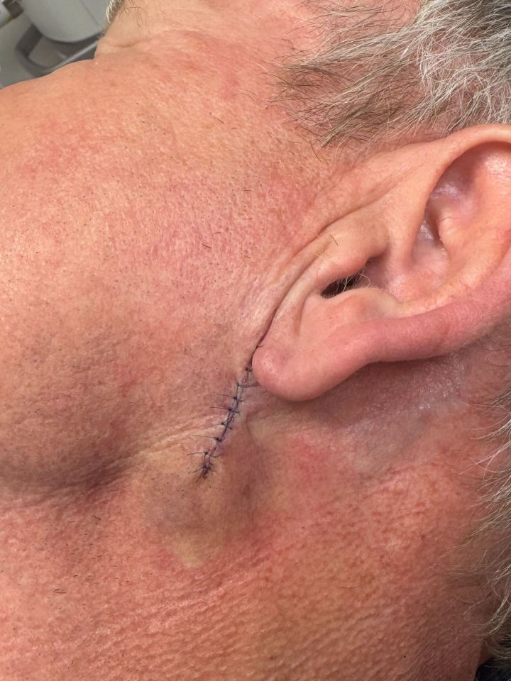 Gordon Ramsay had skin cancer removed: what is known about the chef's diagnosis